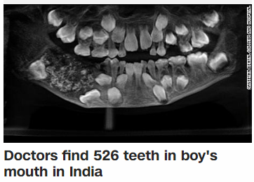 Doctors find 526 teeth in boy's mouth in India